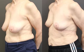 Before and after Breast Reduction case 19793 - Angle 2