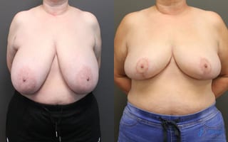 Before and after Breast Reduction case 19795 - Angle 1