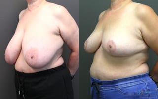 Before and after Breast Reduction case 19795 - Angle 2