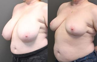 Before and after Breast Reduction case 19799 - Angle 2