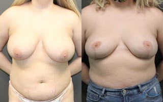 Before and after Breast Reduction case 19800 - Angle 1