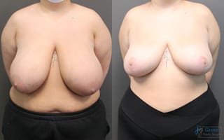 Before and after Breast Reduction case 19802 - Angle 1