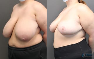 Before and after Breast Reduction case 19802 - Angle 2