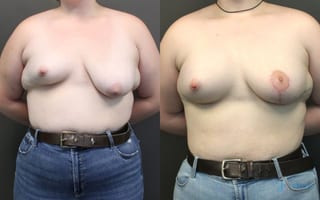 Before and after Asymmetry and tuberous breast case 19809 - Angle 1