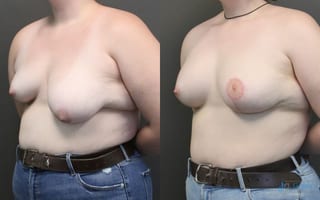 Before and after Asymmetry and tuberous breast case 19809 - Angle 2