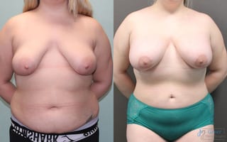 Before and after Liposuction case 19810 - Angle 1
