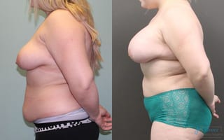 Before and after Liposuction case 19810 - Angle 2