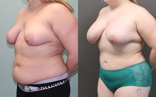 Before and after Liposuction case 19810 - Angle 3