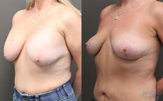 Before and after Revision or Removal of Implants case 19812 - Angle 2