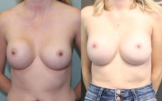 Before and after Revision or Removal of Implants case 19813 - Angle 1