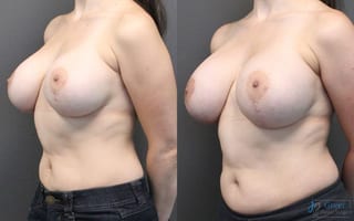 Before and after Revision or Removal of Implants case 19815 - Angle 2