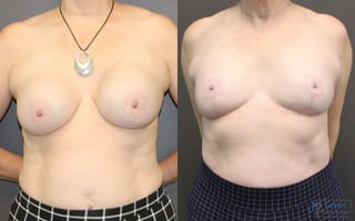 Before and after Revision or Removal of Implants case 19816 - Angle 1
