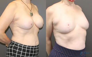 Before and after Revision or Removal of Implants case 19816 - Angle 2