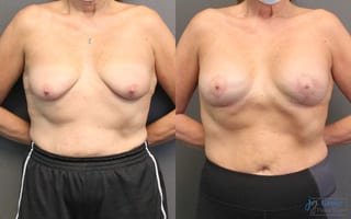 Before and after Breast Augmentation with Lift case 19823 - Angle 1