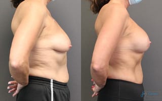 Before and after Breast Augmentation with Lift case 19823 - Angle 2
