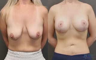Before and after Breast Augmentation with Lift case 19824 - Angle 1