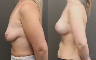 Before and after Breast Augmentation with Lift case 19824 - Angle 2