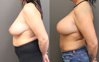 Before and after Breast Augmentation with Lift case 19825 - Angle 2