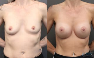 Before and after Breast Augmentation case 19829 - Angle 1