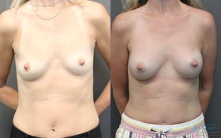 Before and after Breast Augmentation case 19830 - Angle 1