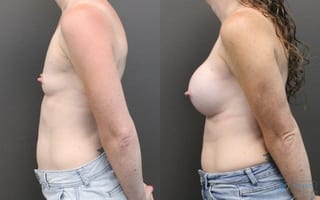 Before and after Breast Augmentation case 19831 - Angle 2