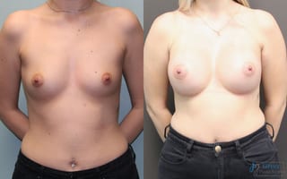 Before and after Breast Augmentation case 19834 - Angle 1