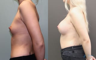 Before and after Breast Augmentation case 19834 - Angle 2