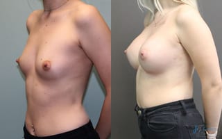 Before and after Breast Augmentation case 19834 - Angle 3