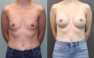 Before and after Breast Augmentation case 19835 - Angle 1