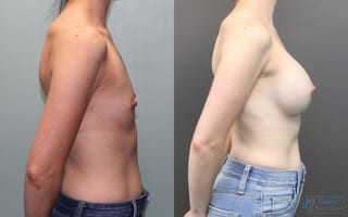 Before and after Breast Augmentation case 19835 - Angle 2