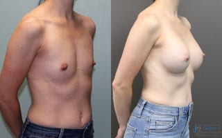Before and after Breast Augmentation case 19835 - Angle 3