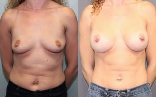 Before and after Breast Augmentation case 19836 - Angle 1