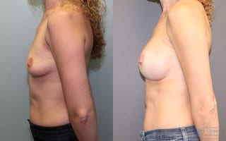 Before and after Breast Augmentation case 19836 - Angle 2