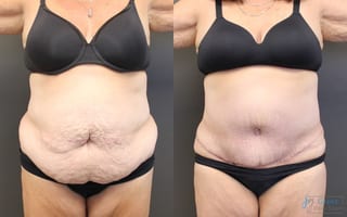 Before and after Abdominoplasty case 19840 - Angle 1