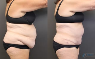 Before and after Abdominoplasty case 19840 - Angle 2