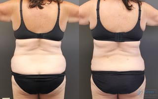 Before and after Abdominoplasty case 19840 - Angle 3