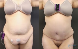 Before and after Abdominoplasty case 19841 - Angle 1