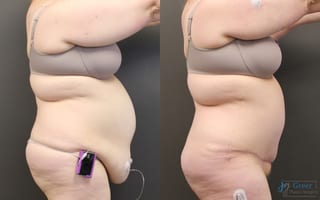 Before and after Abdominoplasty case 19841 - Angle 2