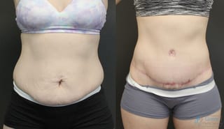 Before and after Abdominoplasty case 19842 - Angle 1