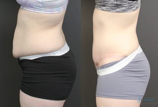 Before and after Abdominoplasty case 19842 - Angle 2