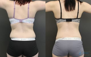 Before and after Abdominoplasty case 19842 - Angle 3