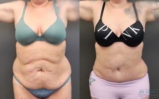 Before and after Abdominoplasty case 19844 - Angle 1
