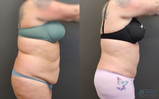 Before and after Abdominoplasty case 19844 - Angle 2