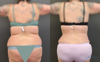 Before and after Abdominoplasty case 19844 - Angle 3