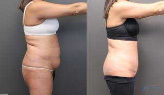 Before and after Abdominoplasty case 19845 - Angle 2