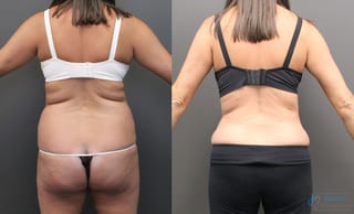 Before and after Abdominoplasty case 19845 - Angle 3