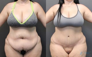 Before and after Abdominoplasty case 19846 - Angle 1
