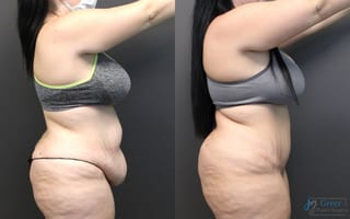Before and after Abdominoplasty case 19846 - Angle 2