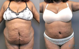 Before and after Abdominoplasty case 19848 - Angle 1