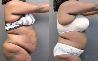 Before and after Abdominoplasty case 19848 - Angle 2